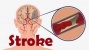 Ternyata, Ini Faktor Risiko Utama Stroke dan Cara Mengatasinya